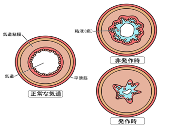 気管支喘息