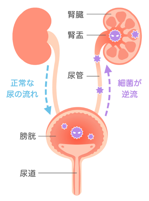 尿路感染症