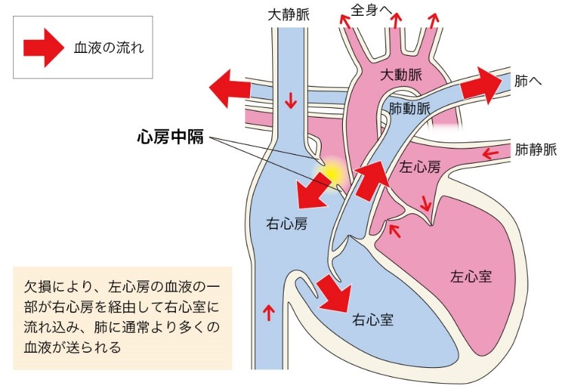 心房中隔欠損症